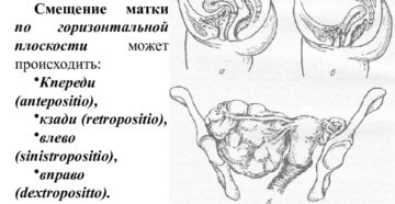 Смещение матки при беременности