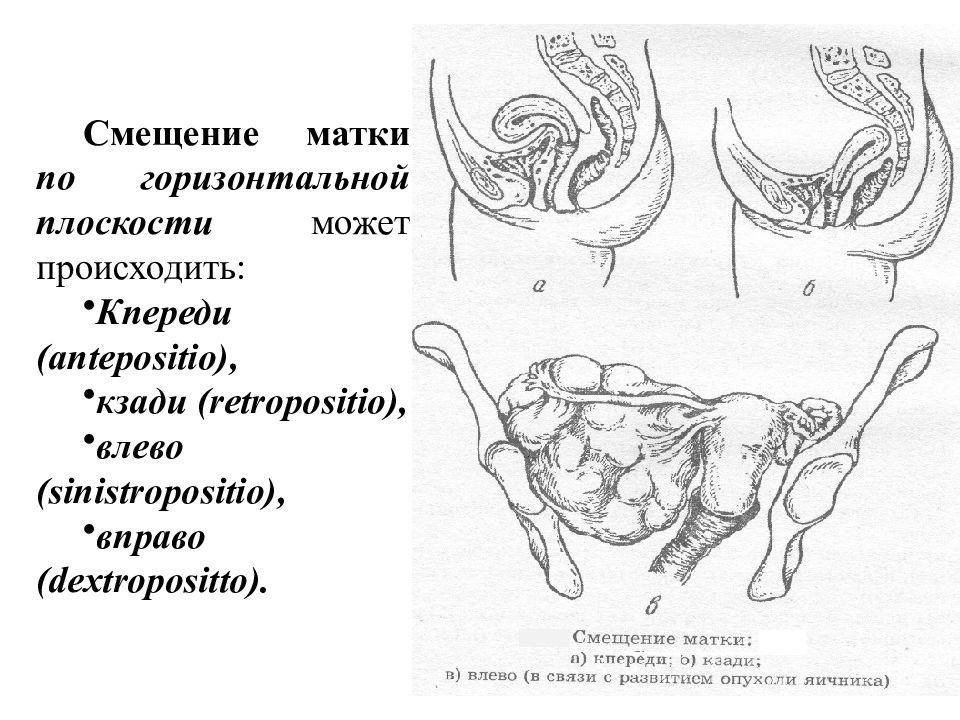 Смещение матки при беременности