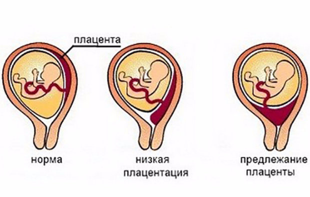 23 недели низкая плацентация