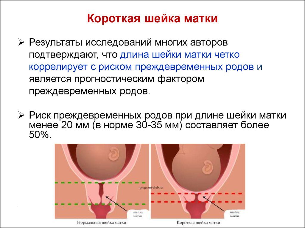 Шейка матки длинная при беременности