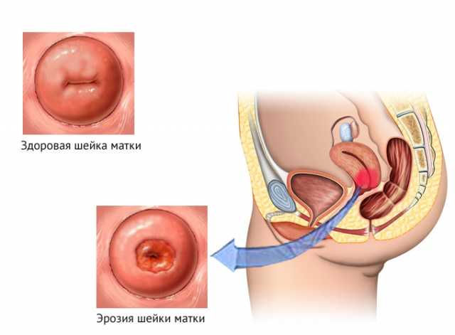 После родов эрозия шейки матки
