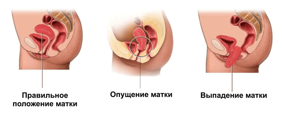 После родов опущение матки